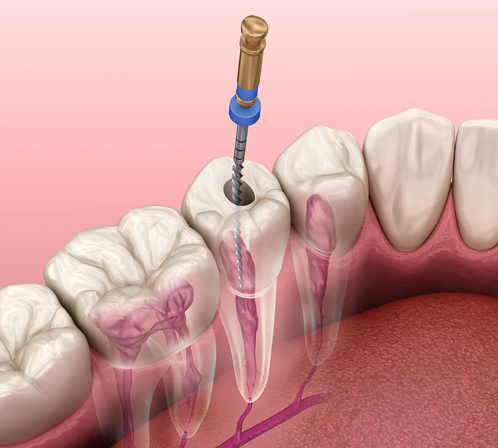 Endodonzia